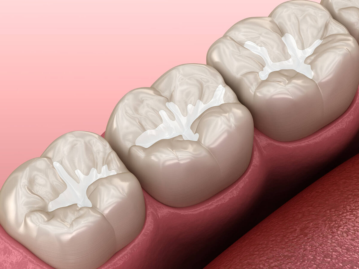 6 Benefits of Dental Sealants