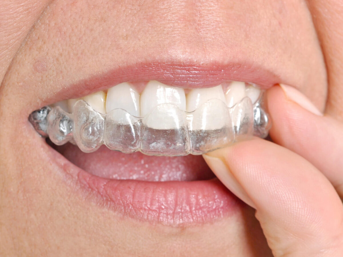 Daily Care Tips For Maintaining Your Invisalign Aligners