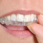 Daily Care Tips For Maintaining Your Invisalign Aligners