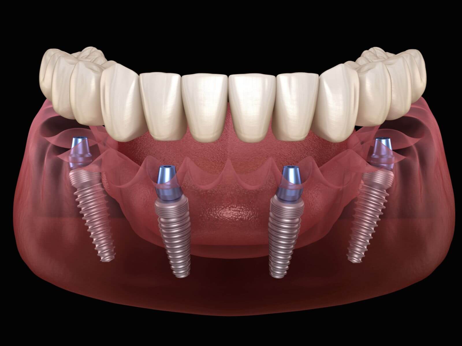 Determining Which Type of Dental Implant Is Right For You