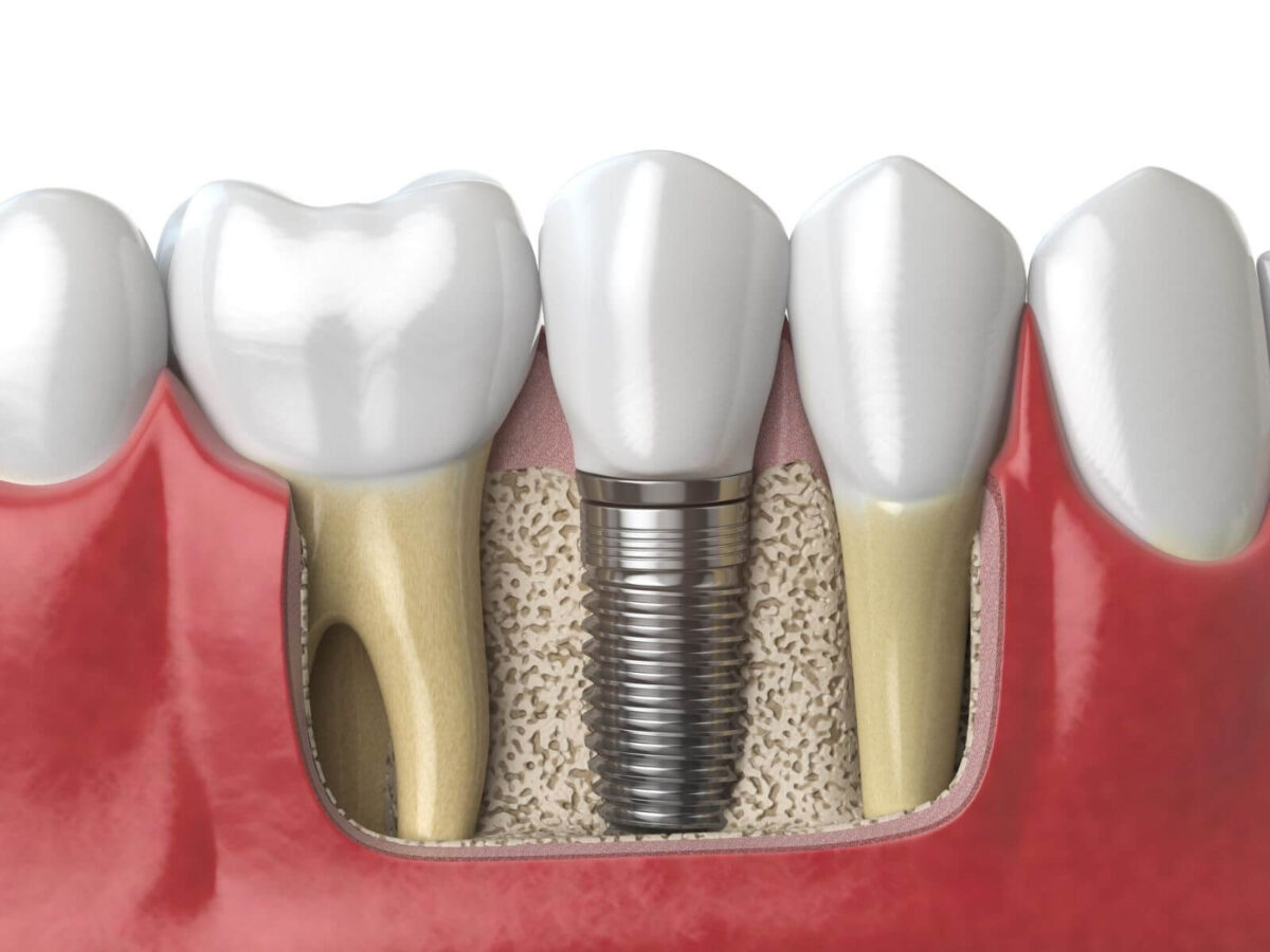 The Benefits of Choosing All-on-X Implants For Full Arch Restoration