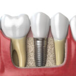 The Benefits of Choosing All-on-X Implants For Full Arch Restoration